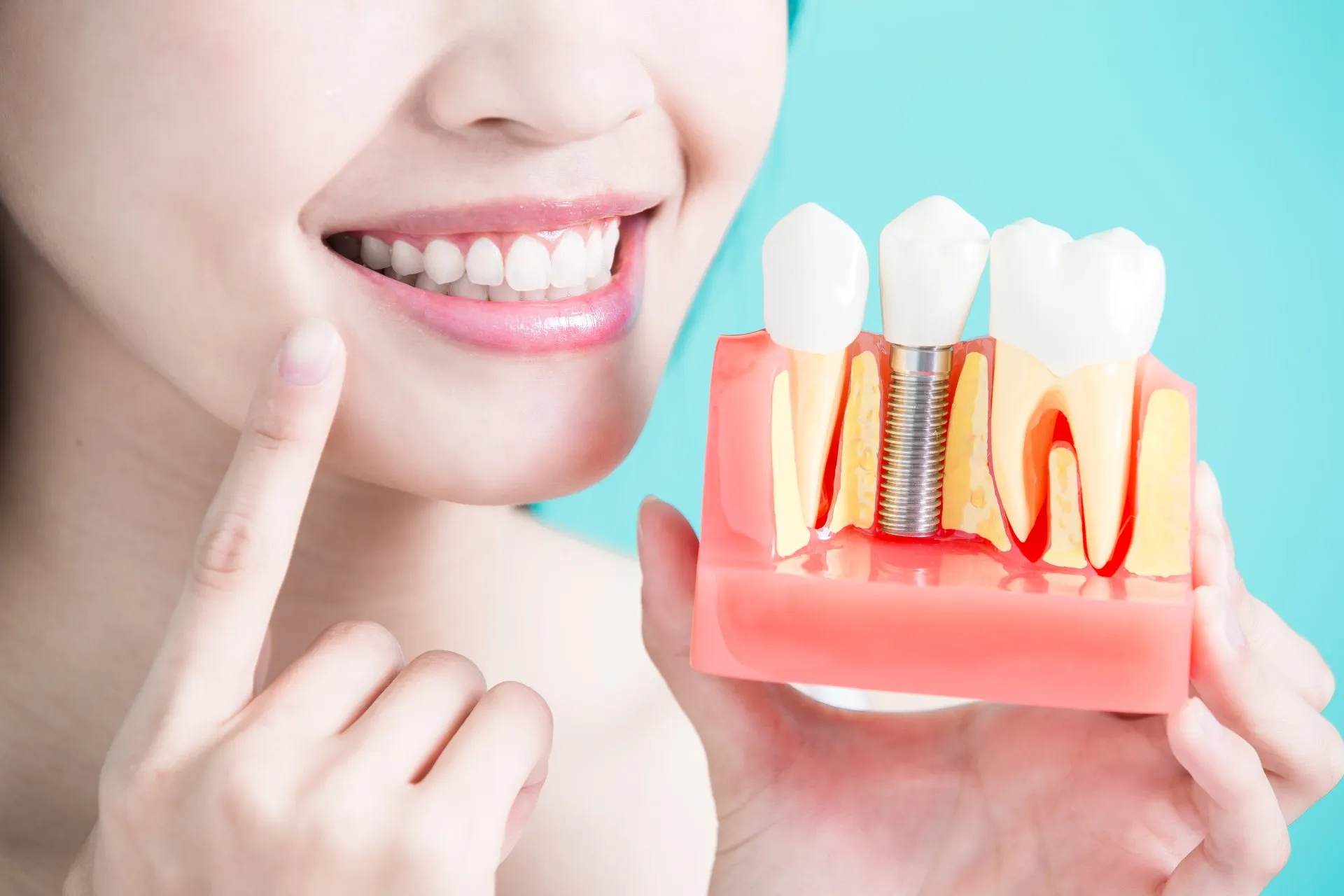 Dental Implants Coquitlam